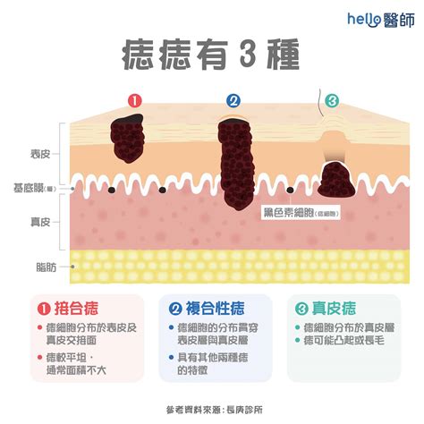 痣太多|為什麼臉上的痣越來越多？皮膚科醫師解析長痣原因、。